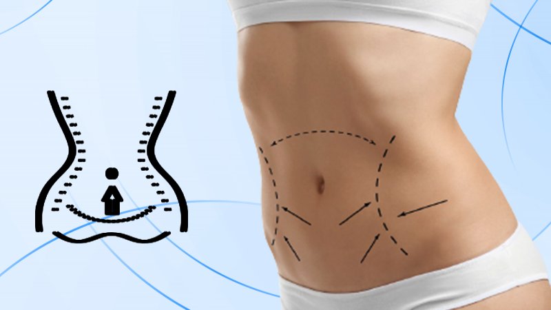 Buikwandcorrectie/ Tummy Tuck