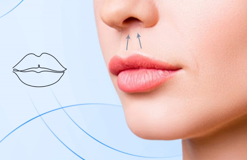 Lip Lift / Dudak Kaldıma