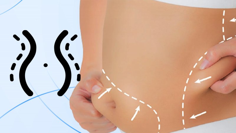 Tummy Tuck, Nuance Cosmetic Surgery